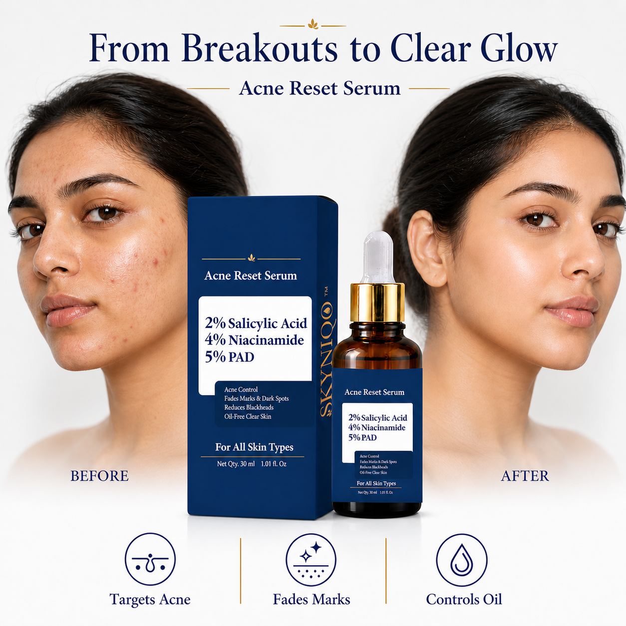 Skyniqo Acne Reset Serum 2% Salicylic + 5% PAD for Acne & Dark Spots 30ml (30 ml)